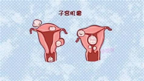 如何 讓 子宮 肌 瘤 變 小